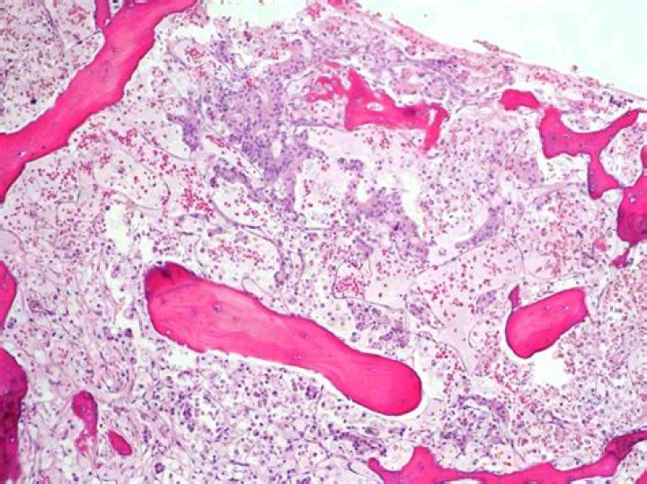 Which term means hypoplasia of bone marrow?