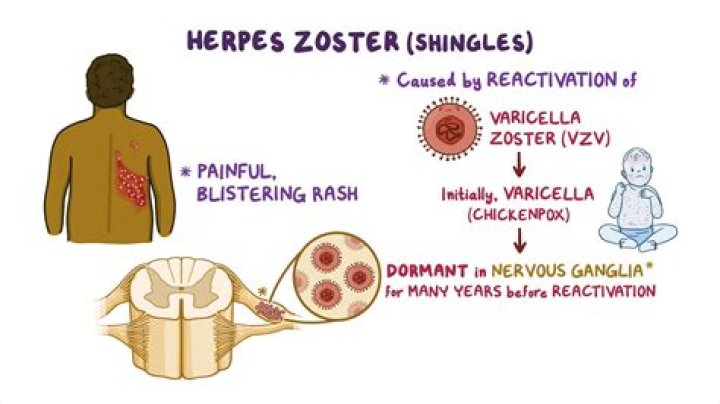 Which virus causes herpes zoster?