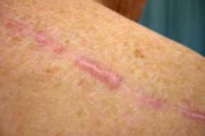 Who can get keloids?