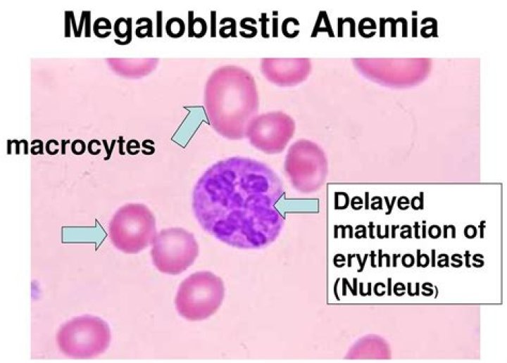 Who discovered megaloblastic anemia?