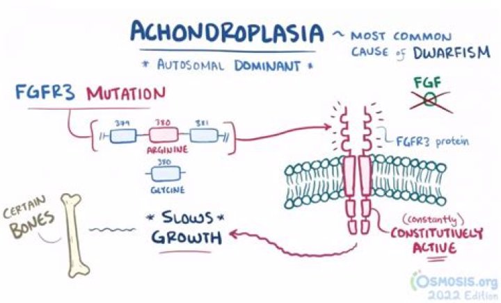 Who has achondroplasia dwarfism?