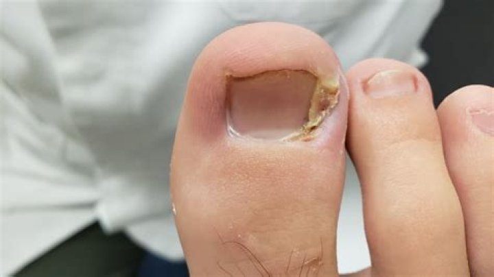 Who helps ingrown toenails?