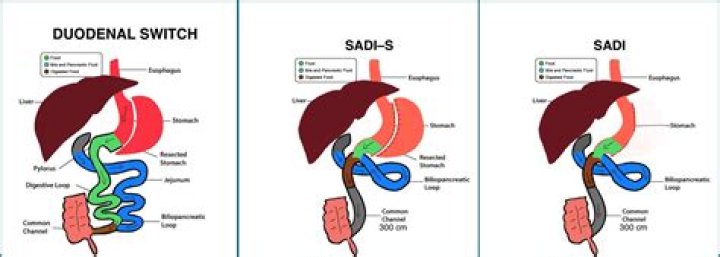 Who invented the duodenal switch?