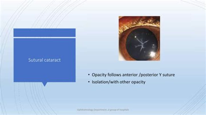 Who is developmental cataract?