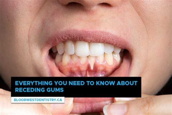 Why am i getting receding gums?