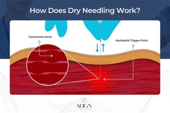 Why does dry needling hurt?