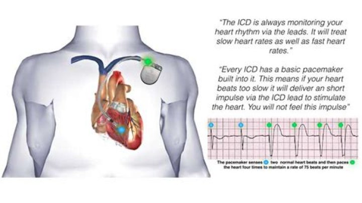 Why is an icd implanted?