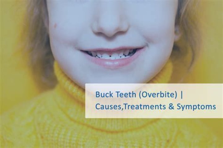 Why is it called buck teeth?