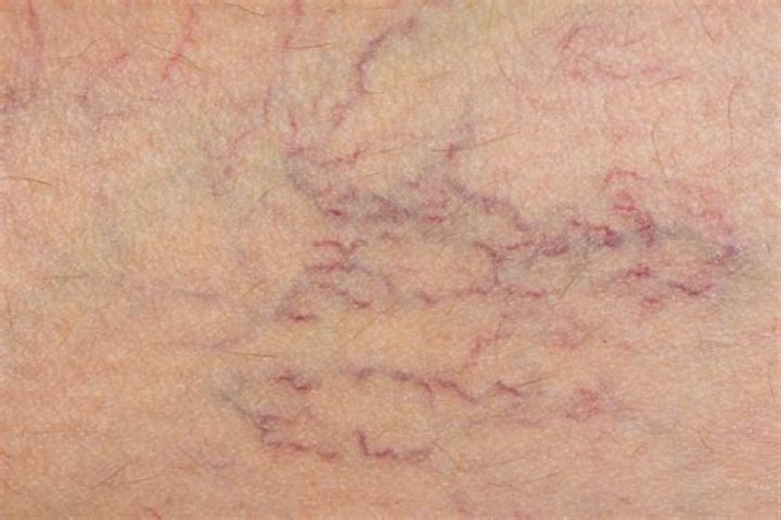 Why varicose veins occur?