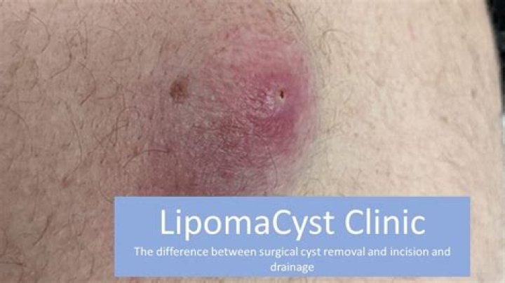 Will a poultice draw out a cyst?