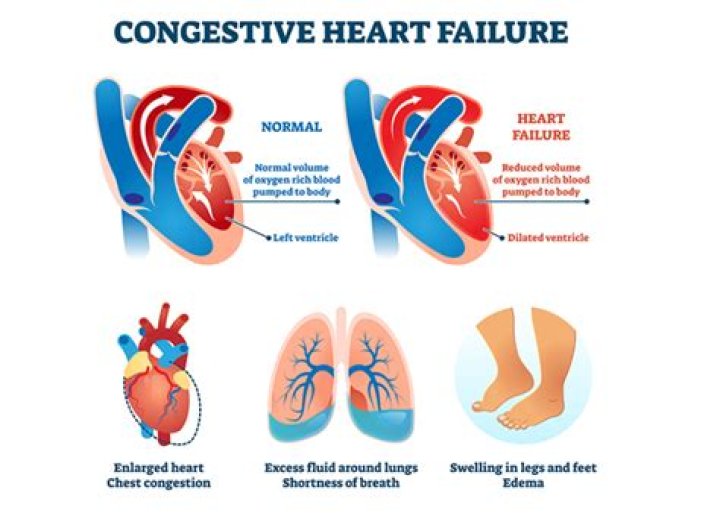 Will an ekg detect congestive heart failure?