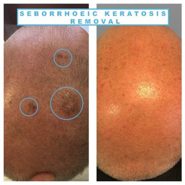 Will compound w remove seborrheic keratosis?