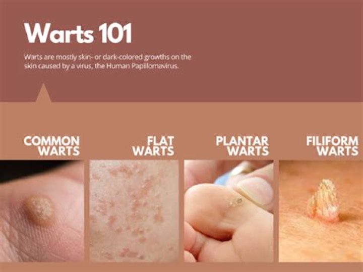 Will mosaic warts go away?