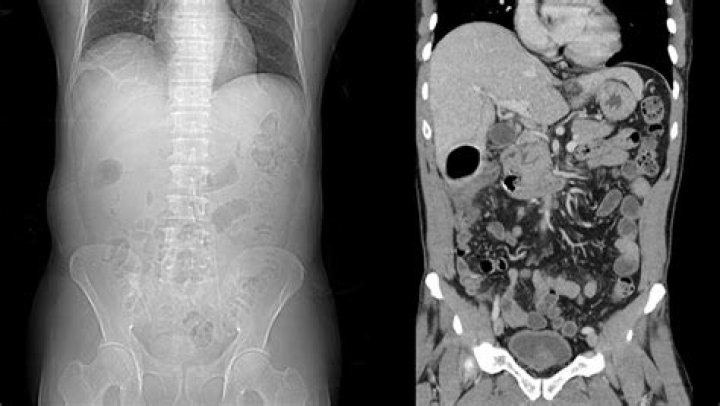 Would a ct scan show lesions?