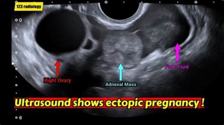 Would ectopic pregnancy show up on blood test?